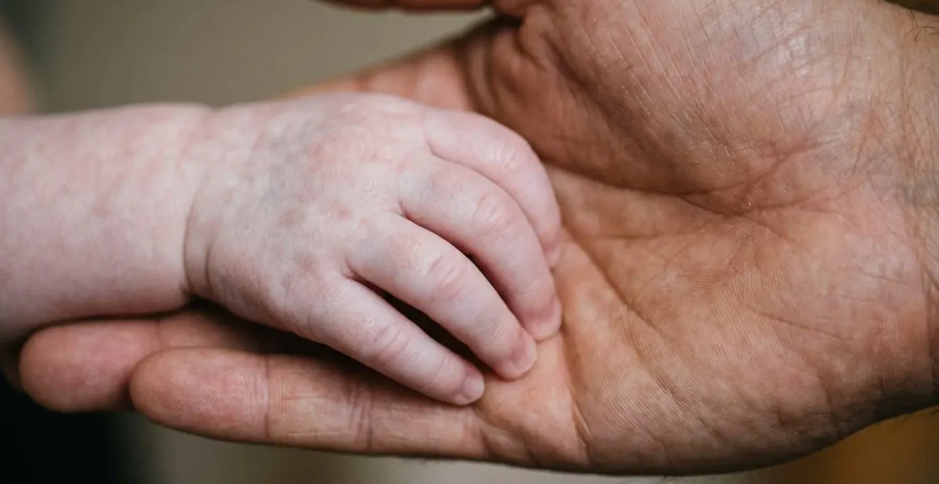 Macro close-up photograph showing a baby's hand with unusual skin mottling and pale coloration against parent's warm hand